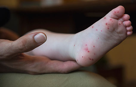 hfmd-childs-foot.jpg